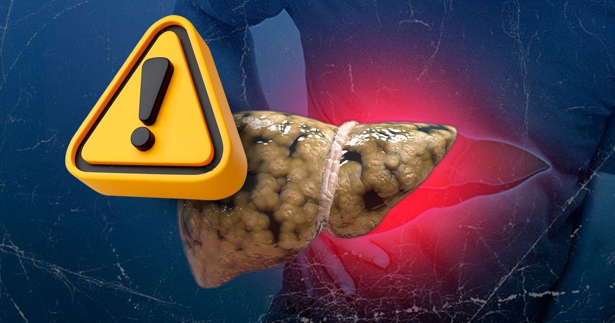 Suplementos para el hígado graso: aliados bajo supervisión médica